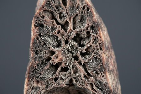 An image of the word pneumonoultramicroscopicsilicovolcanoconiosis as defined by an obscure term ostensibly referring to a lung disease caused by silica dust, sometimes cited as one of the longest words in the English language.